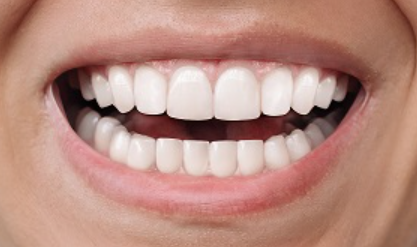 Aligners Globe Before and After treatment