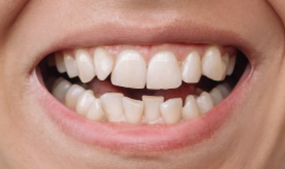 Aligners Globe Before and After treatment