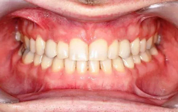 Aligners Globe Before and After treatment