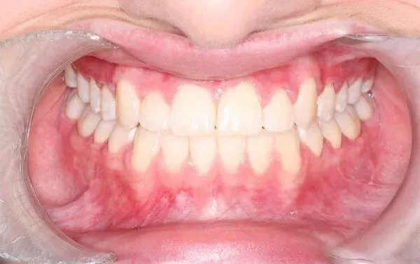 Aligners Globe Before and After treatment
