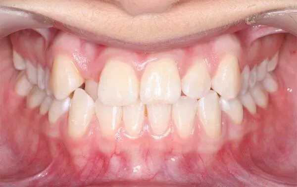 Aligners Globe Before and After treatment