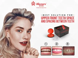 Aligners Globe – Best Solution for Upper Front Teeth Space and Spacing Between Teeth