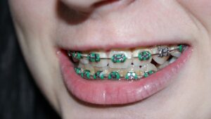Can Braces Fix All Kinds of Teeth That Are Out of Place