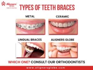 What Are the Different Types of Braces and Which One Is Best for You