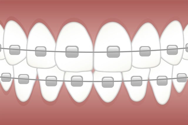 What Are the Different Types of Braces and Which One Is Best for You