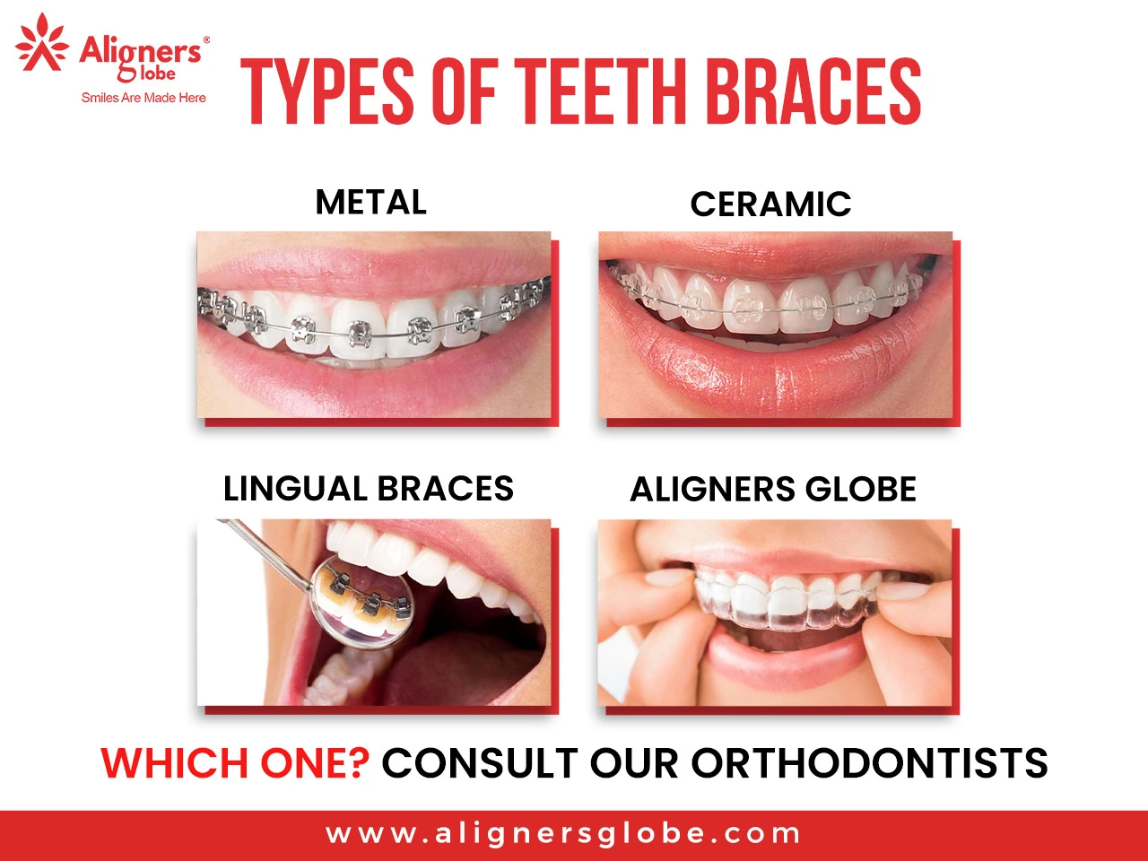 What Are the Different Types of Braces and Which One Is Best for You