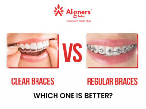 Differences Between Clear Braces and Regular Braces