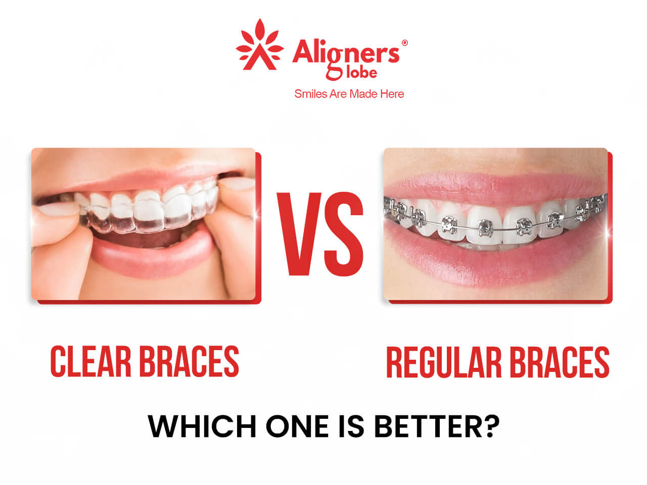 Differences Between Clear Braces and Regular Braces