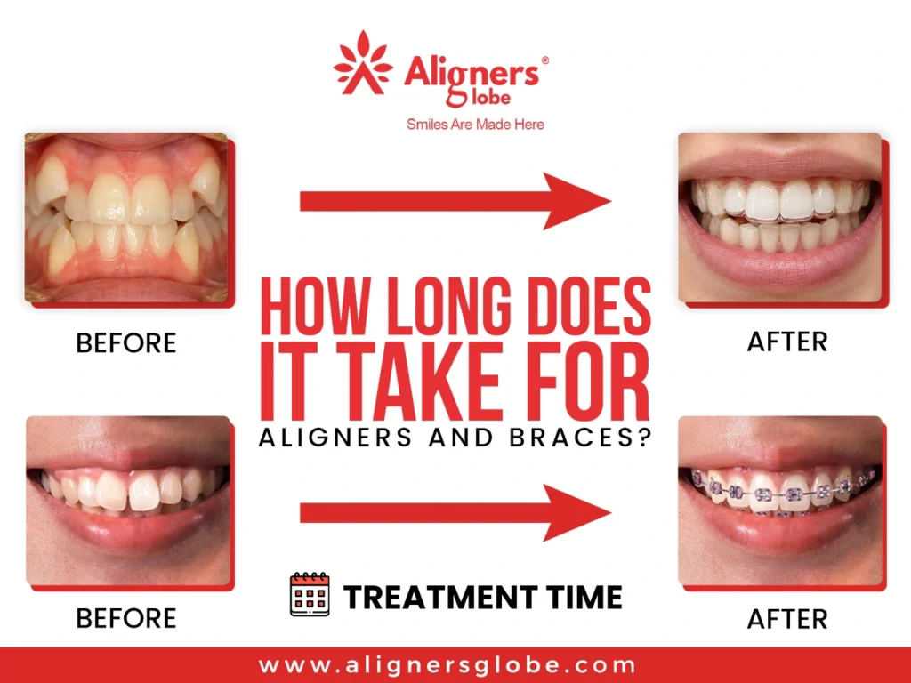 How Long Does It Take for Braces to Work Well to Straighten Teeth?