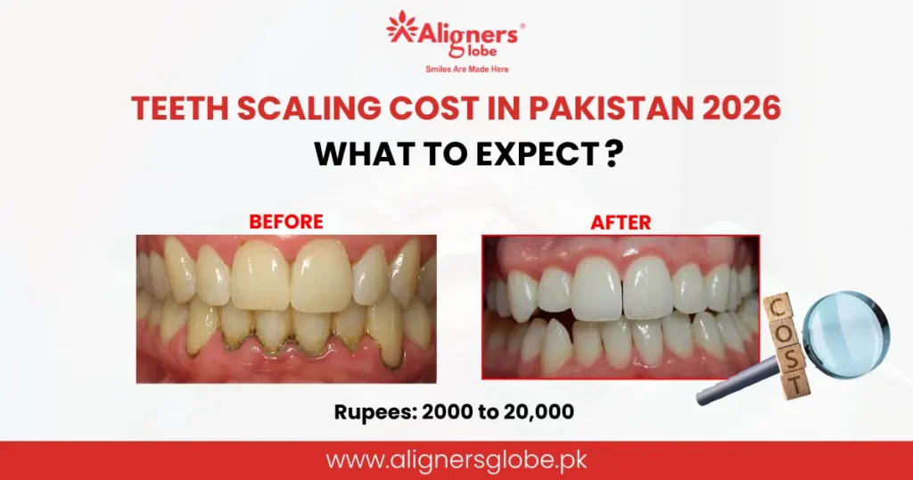 Teeth Scaling Cost in Pakistan