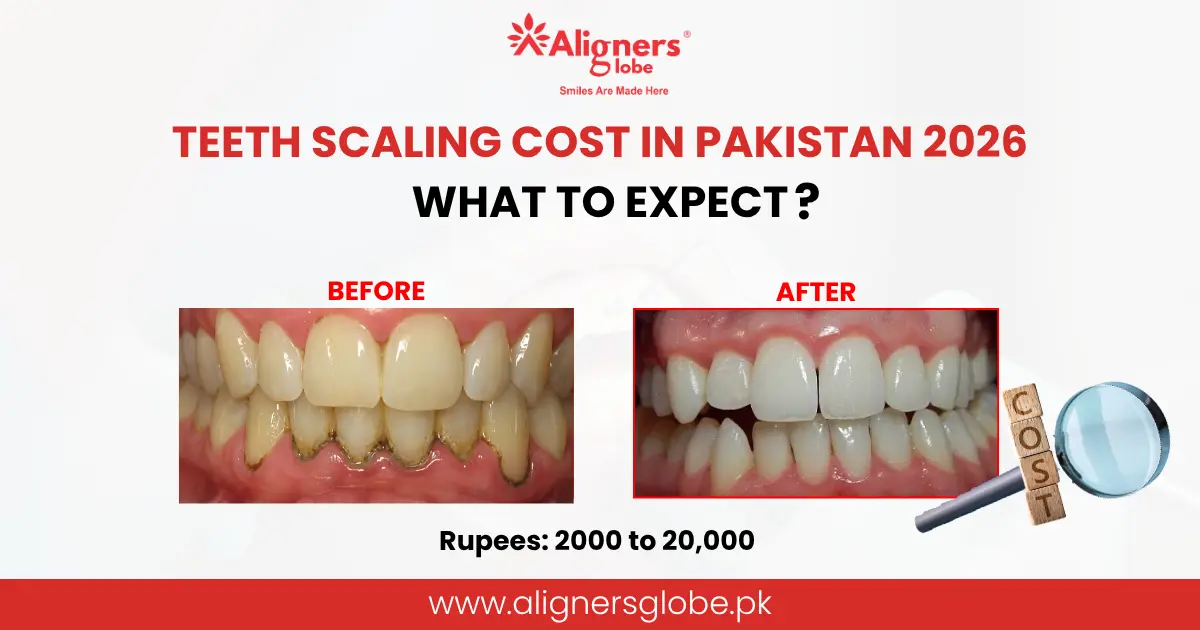 Teeth Scaling Cost in Pakistan