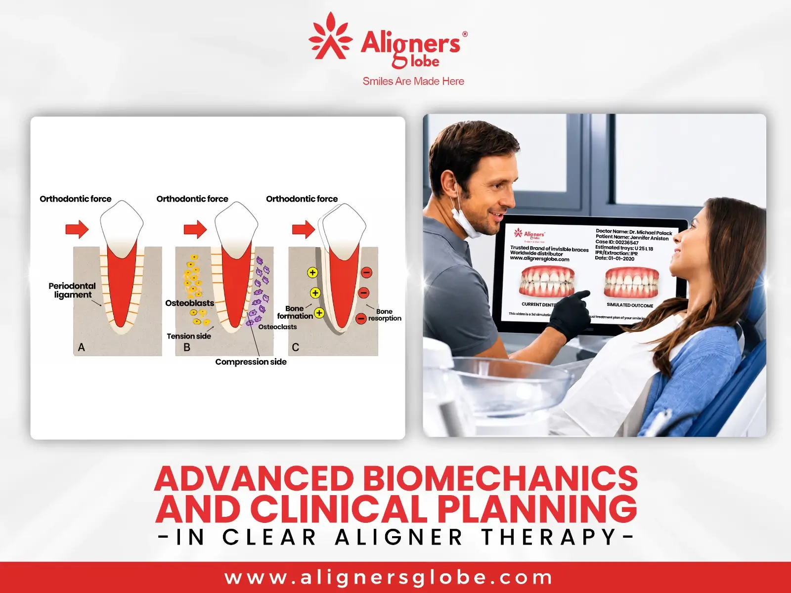 Advanced Biomechanics and Clinical Planning in Clear Aligner Therapy